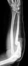 X-ray of <b>Monteggia fracture</b> of