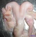 <b>kystes</b> sur <b>l</b>'<b>ovaire</b> gauche