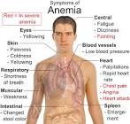<b>Anemia</b> signs and symptoms of