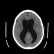 Hydrocephalus - Wikipedia, the free encyclopedia