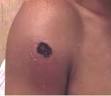 CDC Anthrax | Images: Cutaneous Anthrax
