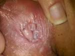 have A LOT of white cluster-like bumps inside my vagina. they ...