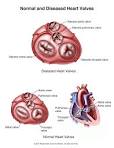 Summit Medical Group - Aortic Valve Regurgitation