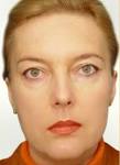 Endoscopic face lift