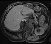 <b>Adenoma</b> - Wikipedia, the free