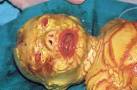 <b>Ichthyosis</b> - diagnosis and