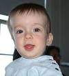 Craniosynostosis - Wikipedia, the free encyclopedia