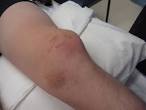 <b>Patella Dislocation</b>