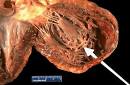 Cardiovascular Pathology