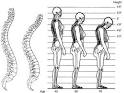 <b>Postmenopausal osteoporosis</b>