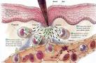 a la <b>inflamación</b>.