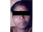 Fibrous dysplasia Search in