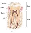 Cracked Teeth and Avoiding Tooth Extraction
