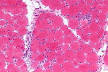 230px-Dermatomyositis_-_high_ ...