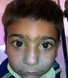 Jaundice - Wikipedia, the free