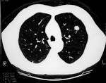 1.5-cm <b>coin lesion</b> in the