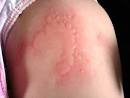 Skin allergic reaction | Josari - Baby Care and Children Health