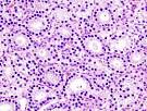 File:Parathyroid adenoma histopathology (2).jpg - Wikipedia, the ...