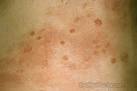 HIV Rash – Pictures, Symptoms and Treatment