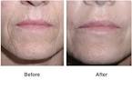 Chemical Peels &amp; Skin Treatments by Newport Beach Cosmetic Surgeon ...