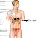 What is Congenital Adrenal Hyperplasia (CAH)? - CARES Foundation