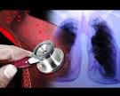 de <b>hipertensión pulmonar</b>