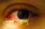 with <b>conjunctivitis</b>.jpg
