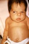 Jaundice: 12 Answers