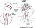 Ischemic Stroke: Stroke (CVA): Merck Manual Home Edition
