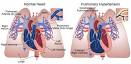 Pulmonary Hypertension :: Nationwide Children's Hospital