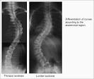Lumbar <b>scoliosis</b> carries a