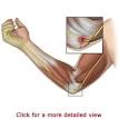 Cubital Tunnel <b>Syndrome</b> is a