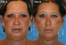 Smoking changes the skin,
