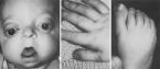 “parrot-beak” nose,