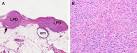 smooth-<b>muscle neoplasm</b> has