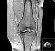 230px-Gonarthrose- ...