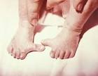 Limb Development <b>Abnormalities</b>
