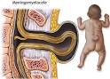 Type of <b>Spina Bifida</b> :