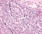 <b>medullary carcinoma</b> is