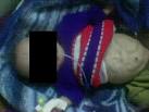 File:<b>Prune belly syndrome</b>.JPEG