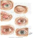 <b>Eyelid</b> Infection and