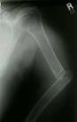 Non Union of <b>Humeral Fractures</b>