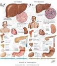 <b>Hemochromatosis</b>…a great reason