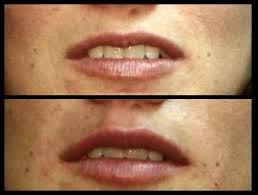 collagen