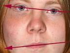 Fibrous Dysplasia - AP View