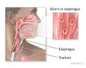 The New York Times > Health > Image > Herpetic Esophagitis