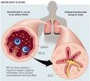 Asthma Attack | Facebook