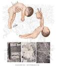 Floppy Baby - Netter Medical Artwork