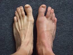  Gout Pain Remedies: Which Gout Pain Remedies Work Best? 