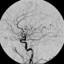 File:Cerebral Angiogram